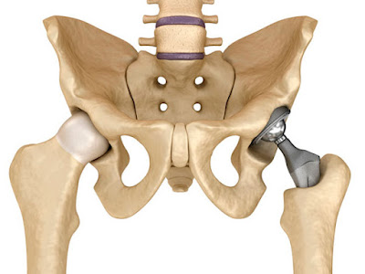 Prótesis de Cadera