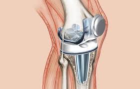 Prótesis de Rodilla